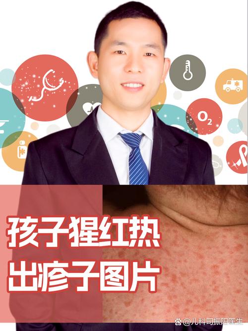 猩红热出现在哪章节?-图2 猩红热出现在哪章节?-图2