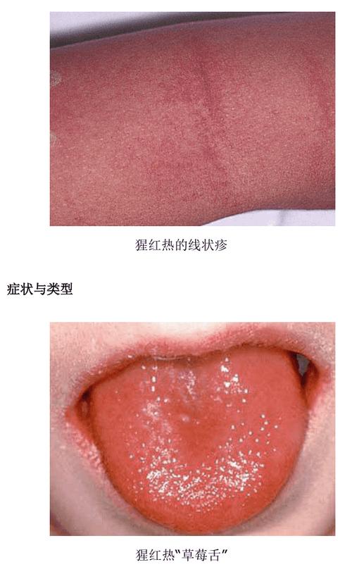 猩红热出现在哪章节?-图3 猩红热出现在哪章节?-图3